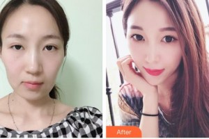 中國人民解放軍第100醫(yī)院整形美容中心陳舒整形價格表附熱瑪吉案例展示