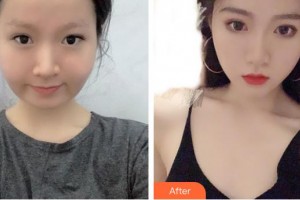 中國人民解放軍第100醫(yī)院整形美容中心汪松林整形價格表附埋線提升案例展示