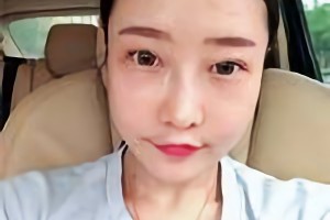 華西口腔醫(yī)院李運峰磨骨手術(shù)價格貴嗎？附價格表和案例