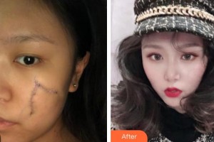 中國醫(yī)學科學院整形外科醫(yī)院滕利整形價格表附激光祛疤案例展示