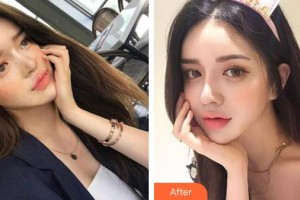 中國醫(yī)學科學院整形外科醫(yī)院整形價格表附彩光嫩膚案例展示