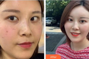 中國醫(yī)學科學院整形外科醫(yī)院穆蘭花整形價格表附激光祛斑案例展示