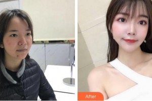 中國醫(yī)學科學院整形外科醫(yī)院劉元波教授整形價格表附微針水光案例展示
