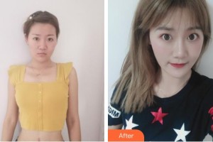 中國醫(yī)學科學院整形外科醫(yī)院宋維銘整形價格表附激光祛疤案例展示