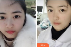 中國醫(yī)學(xué)科學(xué)院整形外科醫(yī)院何樂人整形價(jià)格表附祛斑祛痣案例展示