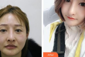 中國醫(yī)學(xué)科學(xué)院整形外科醫(yī)院李斌斌整形價(jià)格表附光子嫩膚案例展示