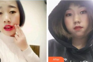 中國航天科工集團(tuán)731醫(yī)院整形美容科陳志剛整形價(jià)格表附根管調(diào)節(jié)案例展示