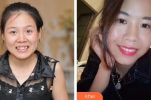 中國醫(yī)科大學(xué)航空總醫(yī)院拇外翻矯正科宋春蘭整形價(jià)格表附自鎖托槽矯正案例展示