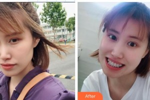 中國醫(yī)科大學(xué)航空總醫(yī)院皮膚激光整形美容中心于紅敏整形價(jià)格表附金屬托槽矯正案例展示
