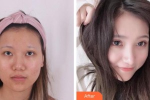 中國科大眼科醫(yī)院劉才遠(yuǎn)整形價(jià)格表附切開雙眼皮案例展示