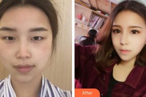 中國醫(yī)科大學(xué)附屬第一醫(yī)院整形外科徐楠整形價(jià)格表附眼部綜合案例展示