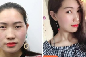 中國醫(yī)科大學(xué)附屬第一醫(yī)院整形外科佟爽整形價(jià)格表附切開雙眼皮案例展示