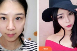 中國醫(yī)科大學(xué)附屬第一醫(yī)院整形外科郭家妍整形價(jià)格表附眼部綜合案例展示