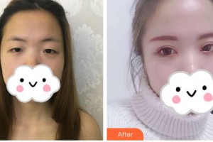 中國醫(yī)科大學(xué)附屬第一醫(yī)院整形外科唐明睿整形價(jià)格表附眼部綜合案例展示