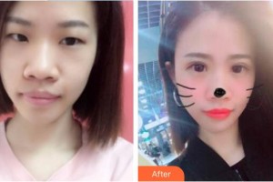 中國醫(yī)科大學(xué)附屬第一醫(yī)院整形外科王玉新整形價(jià)格表附切開雙眼皮案例展示
