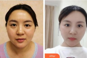 福清天寶美容醫(yī)院熊世文整形價(jià)格表附膨體隆鼻案例展示
