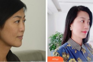 福清天寶美容醫(yī)院葉存祥整形價(jià)格表附鼻部綜合案例展示
