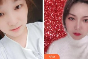 象山愛爾眼科醫(yī)院欒成連整形價(jià)格表附切開雙眼皮案例展示