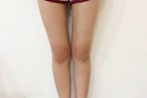 昆明醫(yī)學(xué)院整形美容中心如何？附吸脂瘦腿附果圖及價格一覽