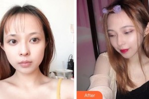 郴州瑞瀾醫(yī)療美容醫(yī)院謝靚整形價(jià)格表附微針美膚案例展示