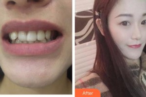 郴州唯美醫(yī)療整形醫(yī)院尹偉力整形價格表附牙齒隱形矯正案例展示