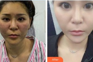 南方醫(yī)院整形美容科姜平整形價格表附埋線提升案例展示