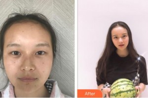 樂(lè)清開(kāi)發(fā)區(qū)醫(yī)院眼科王澤整形價(jià)格表附眼部綜合案例展示