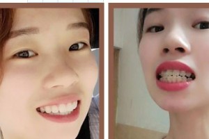 暨南大學附屬第一醫(yī)院整形美容激光中心劉宏偉  整形價格表附冷光美白案例展示