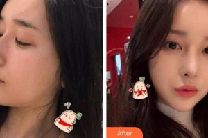 南華大學附屬第二醫(yī)院醫(yī)療美容科楊鋒整形價格表附鼻骨矯正案例展示