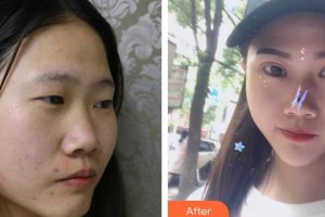 佛山新容奇醫(yī)院眼科胡小成整形價(jià)格表附切開雙眼皮案例展示