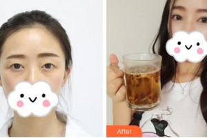 佛山華廈眼科醫(yī)院黎嬋余整形價(jià)格表附定點(diǎn)雙眼皮案例展示