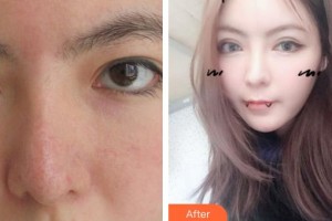 連云港徐楊醫(yī)療美容門診部孫忠林整形價(jià)格表附切開(kāi)雙眼皮案例展示