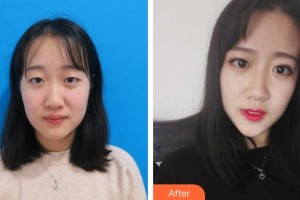 連云港美締整形美容診所李海詩(shī)整形價(jià)格表附切開(kāi)雙眼皮案例展示