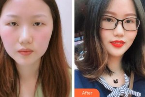 南昌大學(xué)附屬眼科醫(yī)院周文天整形價(jià)格表附切開雙眼皮案例展示