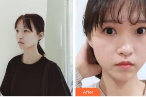 南昌愛爾眼科醫(yī)院易文殊整形價格表附眼部綜合案例展示