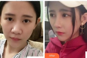南昌愛(ài)爾眼科醫(yī)院黃海整形價(jià)格表附切開(kāi)雙眼皮案例展示