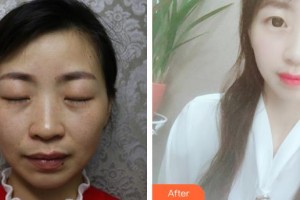南昌愛爾眼科醫(yī)院盧恒松整形價格表附眼部綜合案例展示