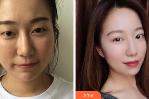 南昌大學附屬眼科醫(yī)院鄒瓊整形價格表附定點雙眼皮案例展示