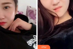 雞西王杰口腔診所王杰整形價格表附根管調(diào)節(jié)案例展示