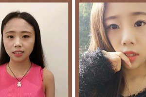 瑞安雅正口腔門診部葉潔整形價格表附牙齒隱形矯正案例展示
