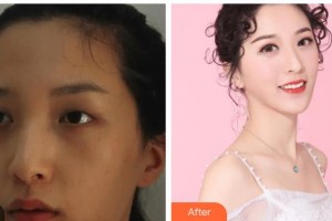 瑞安雅正口腔門診部孔維展整形價格表附隱形托槽矯正案例展示