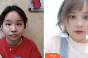 乳山新視力眼科醫(yī)院張軍富整形價格表附定點雙眼皮例展示