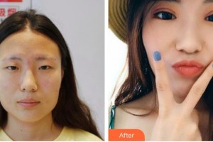 甘肅省康復(fù)中心醫(yī)院眼科中心王登廷整形價(jià)格表附切開雙眼皮案例展示