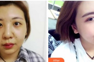 甘肅省人民醫(yī)院燒傷整形科劉俊玲整形價(jià)格表附切開雙眼皮案例展示