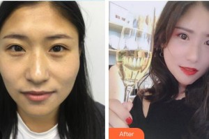 諸暨市人民醫(yī)院整形外科朱樂生整形價(jià)格表附切開雙眼皮案例展示