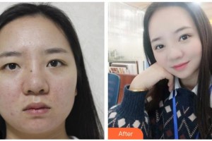 諸暨愛爾眼科醫(yī)院李志強(qiáng)整形價格表附切開雙眼皮案例展示