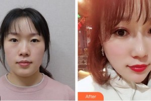榮成眼科醫(yī)院姚毅整形價(jià)格表附切開雙眼皮案例展示