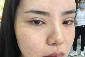 萬(wàn)家燕王珍祥做下頜角怎么樣截的多嗎？附案例分享+較新價(jià)格表
