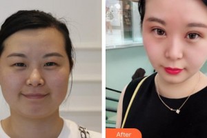龍口光明眼科醫(yī)院金震整形價格表附定點雙眼皮案例展示