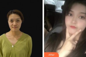 龍口光明眼科醫(yī)院李壽慶整形價格表附眼部修復(fù)案例展示